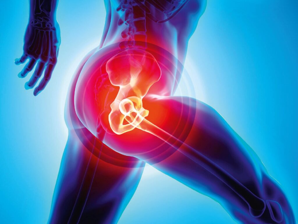 Total Hip Replacement 